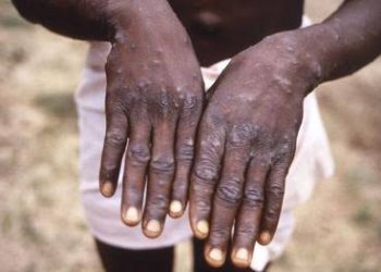 MONKEYPOX: WHO Declares Mpox Outbreak a Global Health Emergency