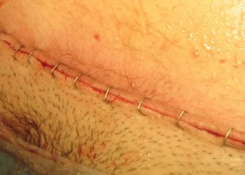 The Importance of Delaying the First Bath After a C-Section: A Guide to Postpartum Care