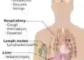 Understanding Cancer: Simple Ways to Prevent It and Why Early Detection Matters