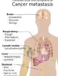 Understanding Cancer: Simple Ways to Prevent It and Why Early Detection Matters