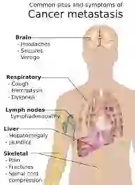 Understanding Cancer: Simple Ways to Prevent It and Why Early Detection Matters