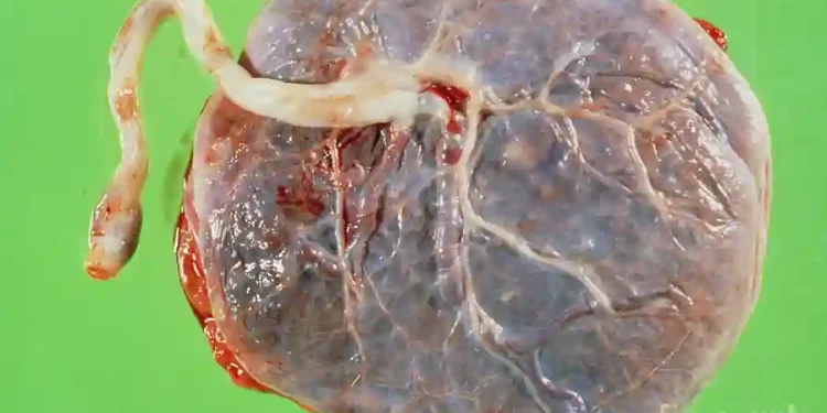 Dried placenta may help men regain erections faster after prostate surgery – Study